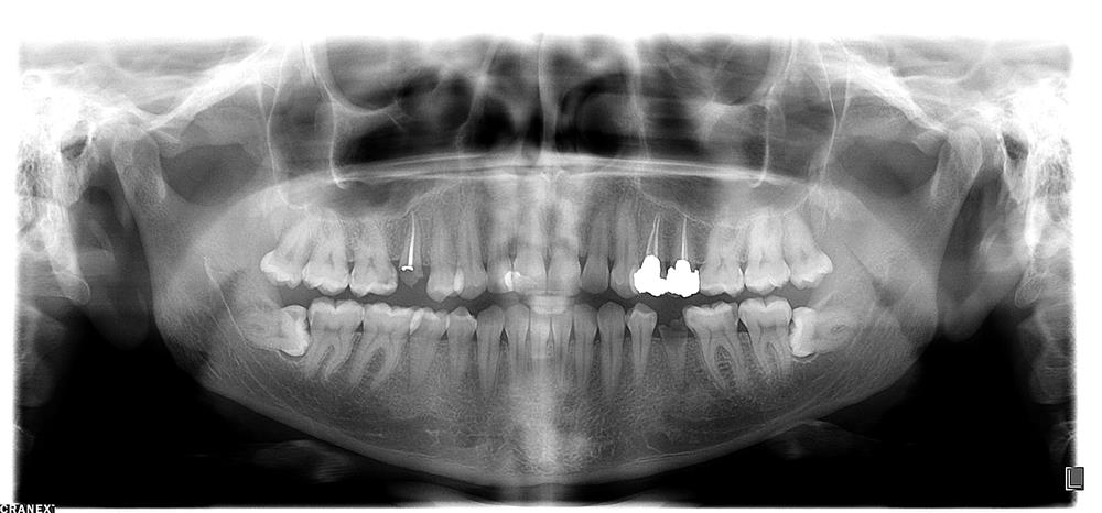 عکس پانورامیک دندان (اصطلاحا OPG)  چیست ؟